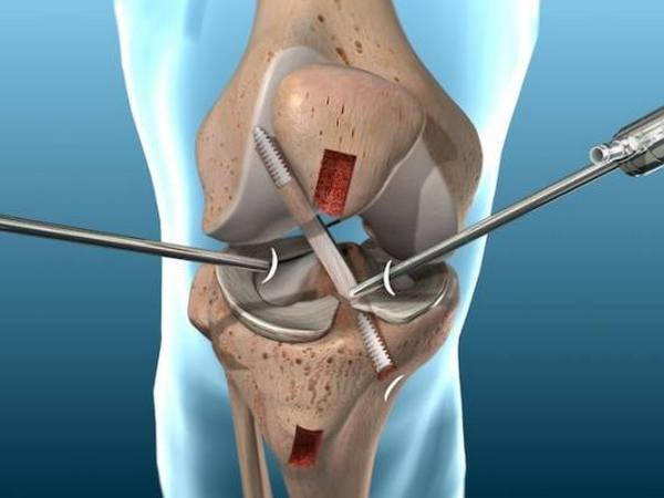 Артроскопия коленного сустава: за и против