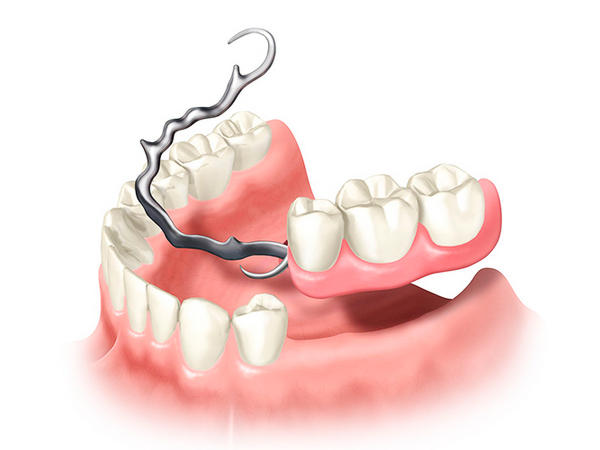 Види протезування зубів