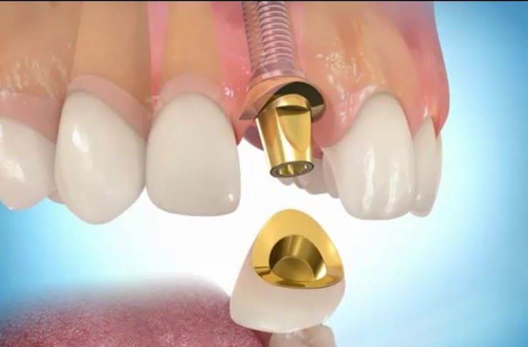 Воспаление после имплантации зубов: можно ли его избежать и как лечить